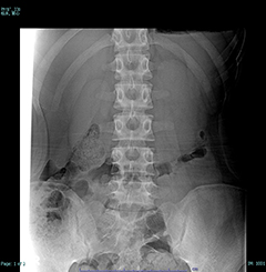 腰椎の動きを見るダイナミックレントゲン