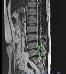 腰椎椎間板ヘルニアCT